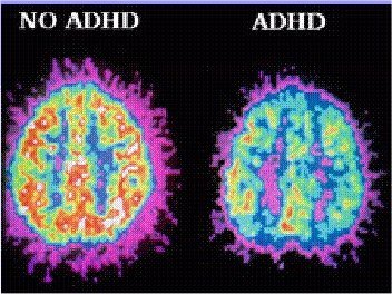 attention deficit disorder add adhd Attention Deficit Hyperactivity Disorder