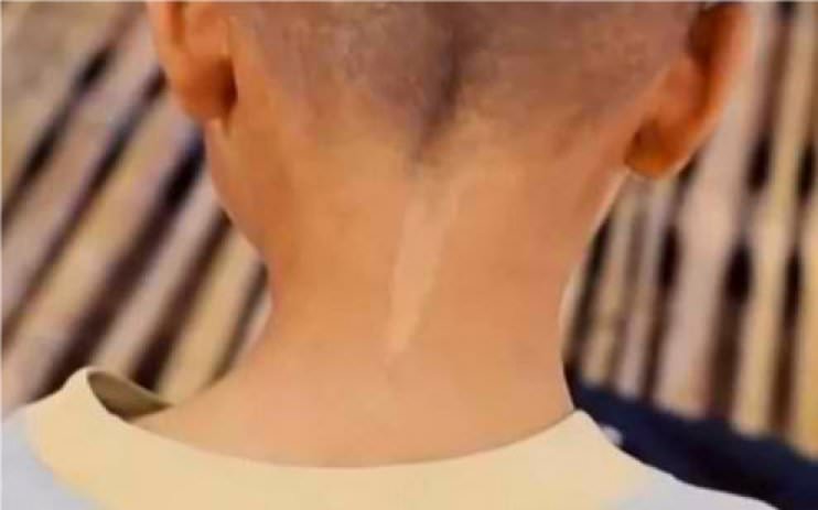 A boy in Thailand with a birthmark on his neck that mirrors the mark made on his grandmother’s neck before she died, shortly before his birth. (Screenshot/YouTube)